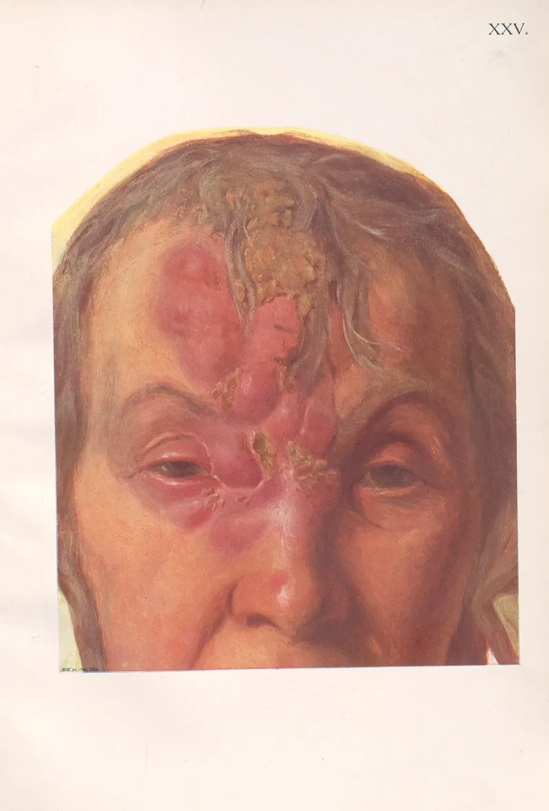 Venereal Diseases Syphilis Pl 25