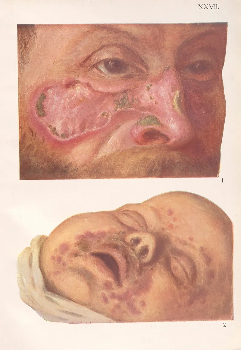 Venereal Diseases Syphilis Pl 27