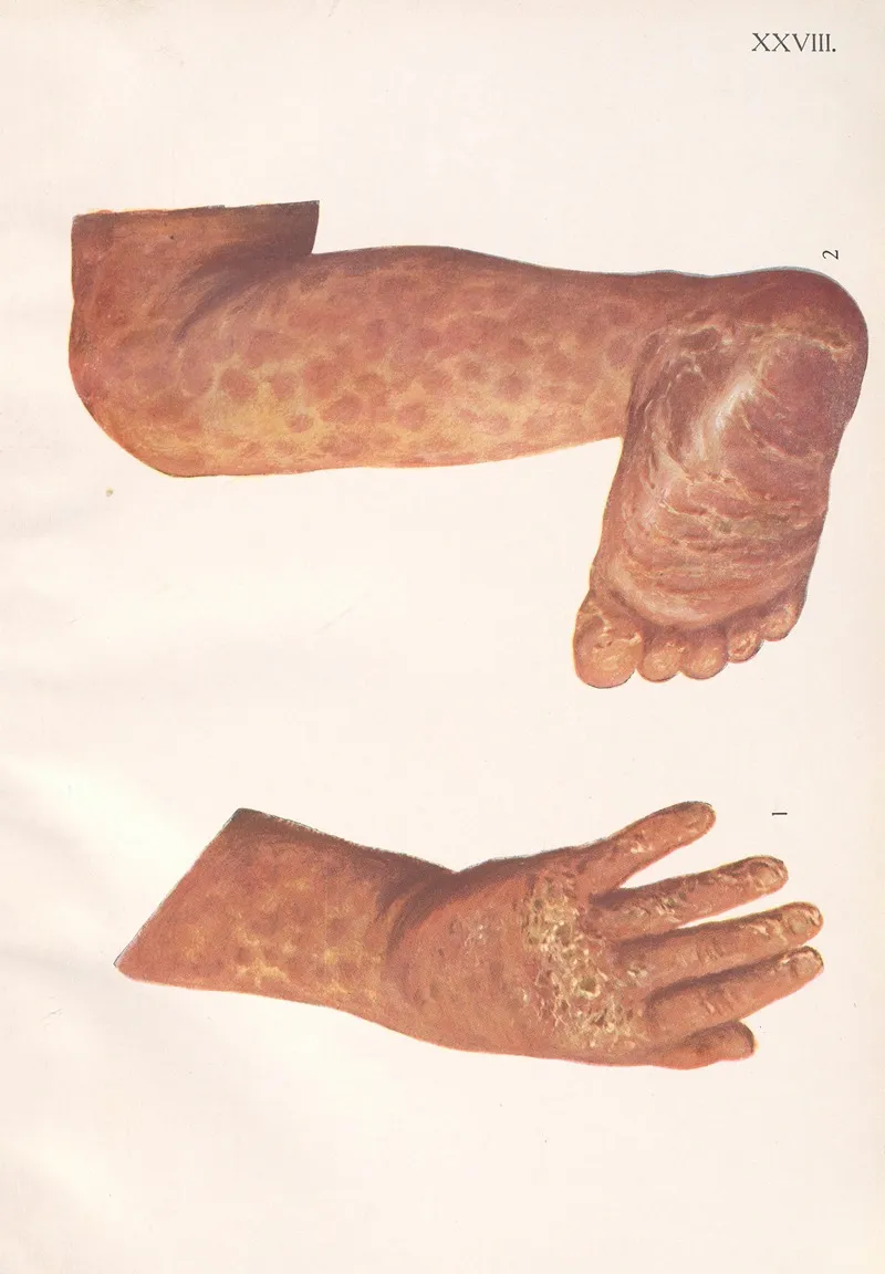 Venereal Diseases Syphilis Pl 28