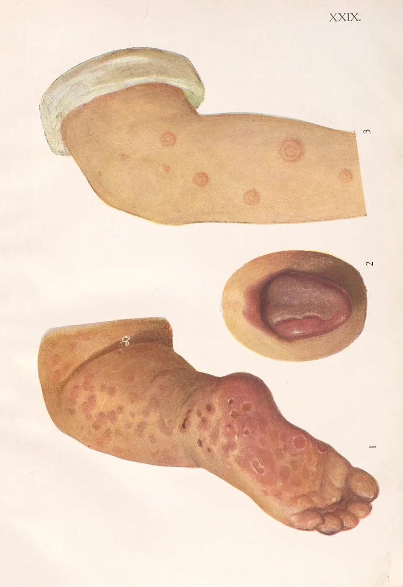 Venereal Diseases Syphilis Pl 29