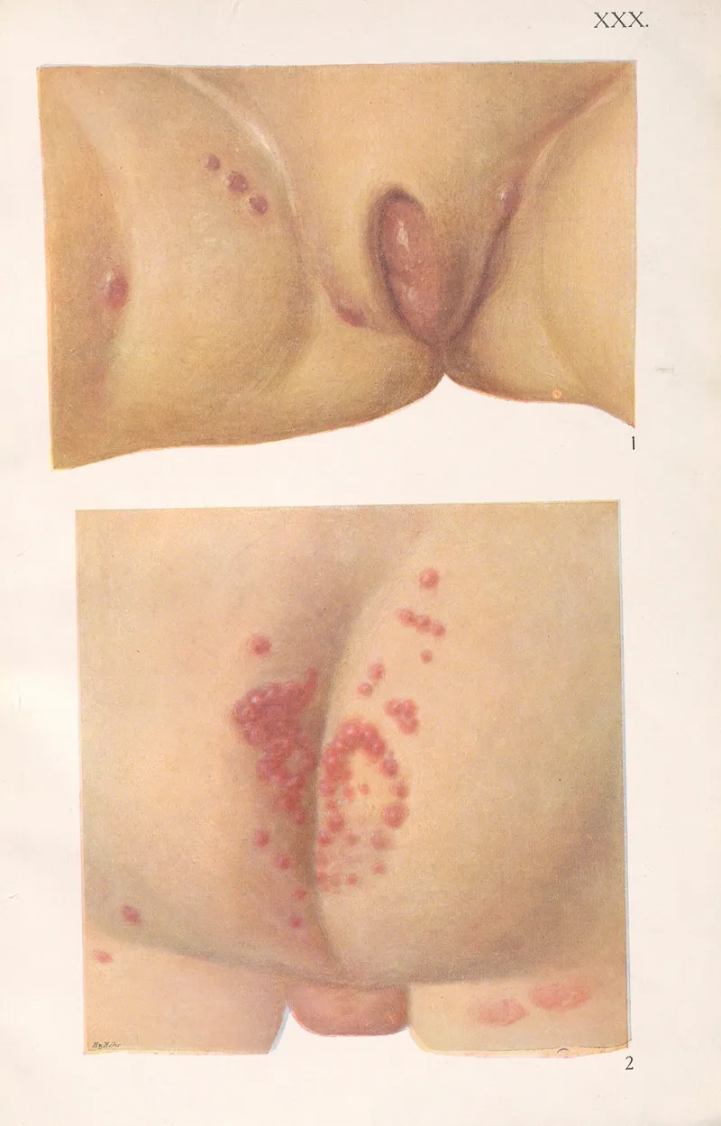 Venereal Diseases Syphilis Pl 30