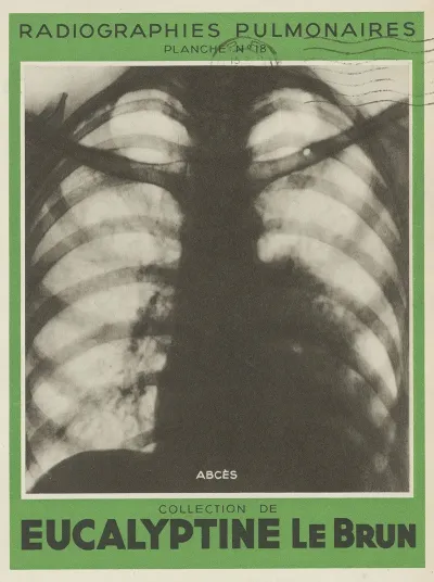 Abces