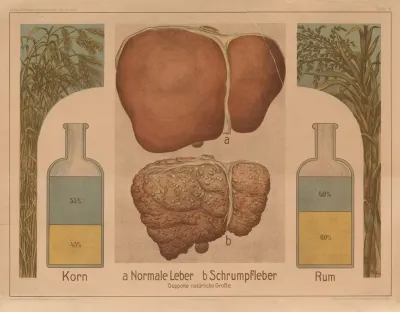 Alcohol Normal Liver And Cirrhosis