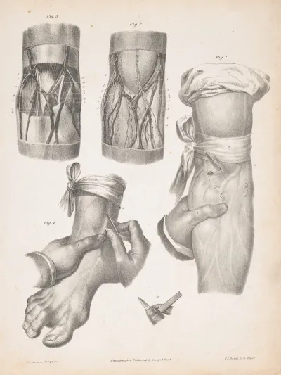 Blood Vessels In An Arm And A Foot With Two Sections Of An Arm Or Leg Showing The Anatomy Beneath The Skin