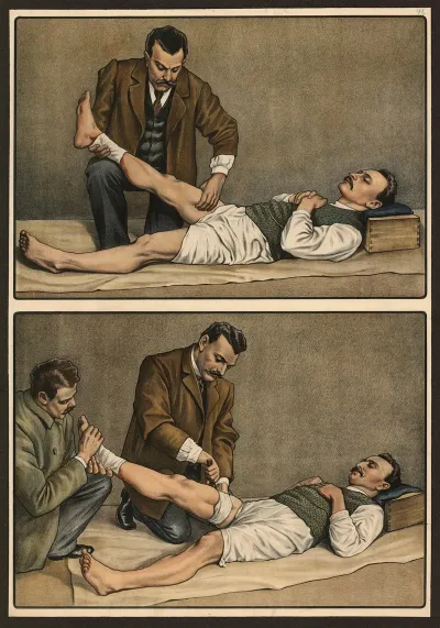 Broken Bones