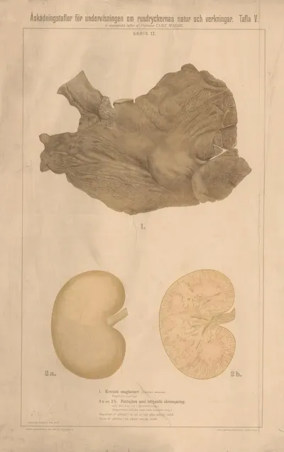 Chronic Gastritis And Fatty Liver With Early Stages Of Cirrhosis