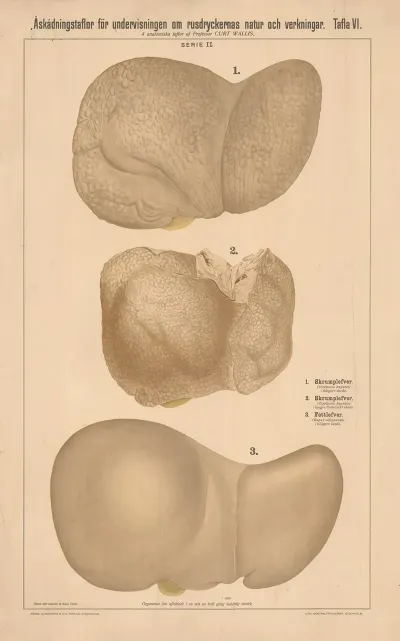 Cirrhosis And Fatty Liver