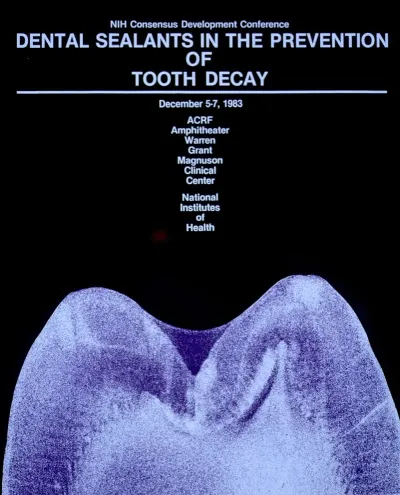 Dental Sealants In The Prevention Of Tooth Decay