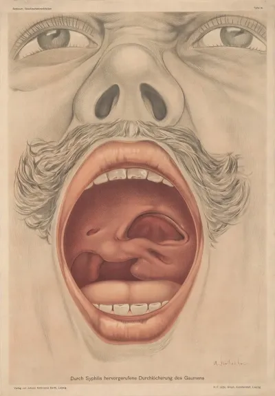 Durch Syphilis Hervorgerufene Durchlocherung Des Gaumens