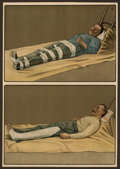 Emergency Treatment For Broken Bones