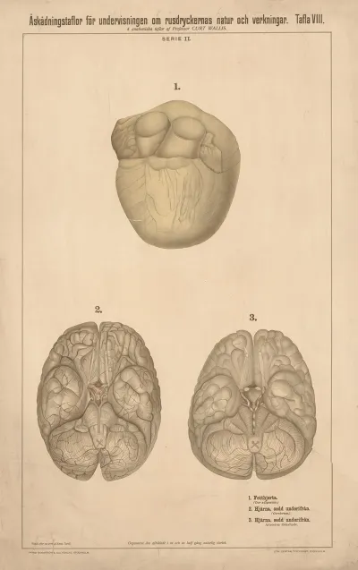 Fatty Heart Healthy Brain And Calcified Brain
