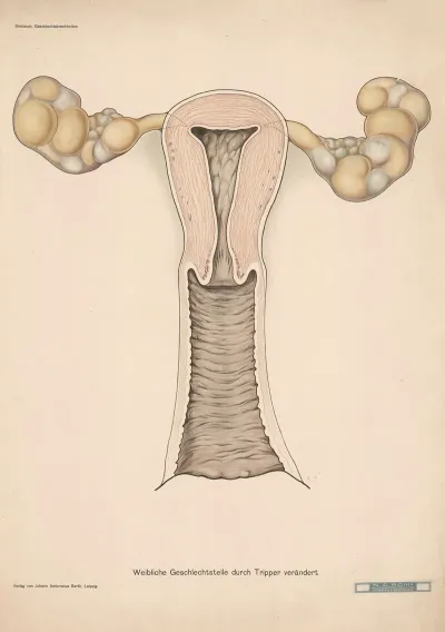 Female Reproductive Organs Altered By Gonorrhea