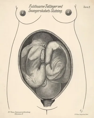 Full Term Twins At The End Of Pregnancy