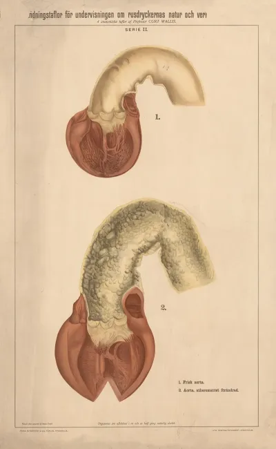 Healthy Aorta And Unhealthy Aorta