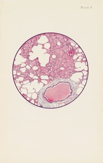 Plate I Microscopic Section Of Human Lung From Phosgene Shell Poisoning Death At The Nineteenth Hour After Gassing
