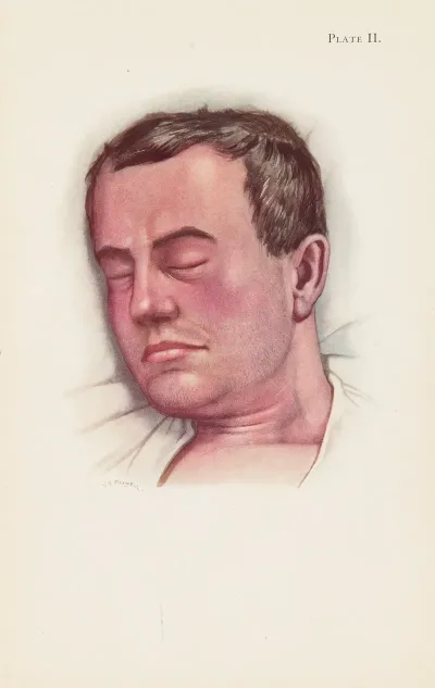 Plate Ii Blue Type Of Asphyxia From Phosgene Poisoning With Intense Venous Congestion