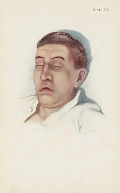 Plate Iii Pallid Type Of Asphyxia From Phosgene Poisoning With Circulatory Failure