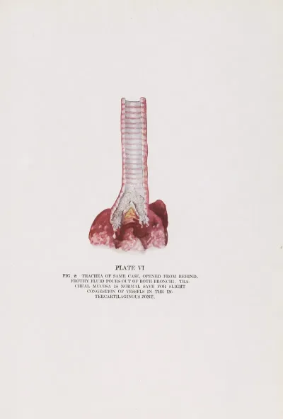 Plate Vi Fig 2 Trachea Of Same Case Opened From Behind