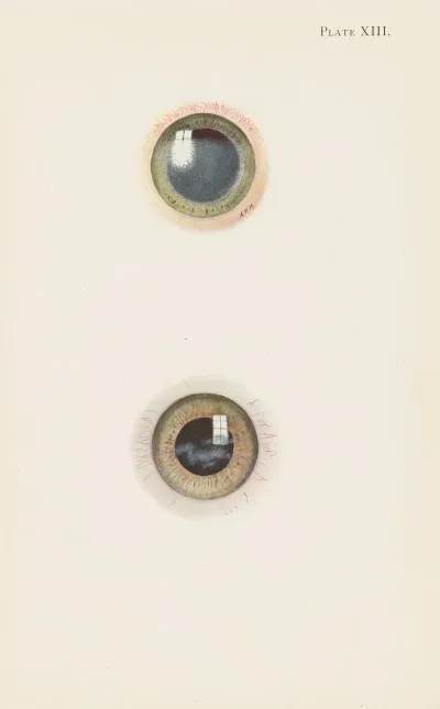 Plate Xiii A Drawing Of The Cornea In The Acute Stage Of Severe Burning B Drawing Of Cornea In The Stage Of Resolution After Severe Burning