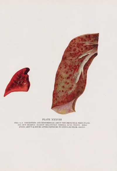 Plate Xxxviii Figs 8 9 Congestion And Hemorrhage About The Bronchial Tree Standing Out Sharply Against Relatively Normal Lung Tissue