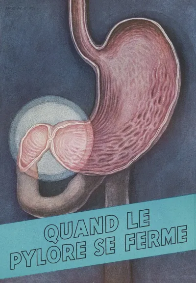 Quand Le Pylore Se Ferme