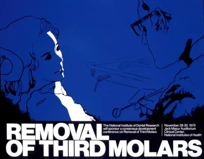 Removal Of Third Molars
