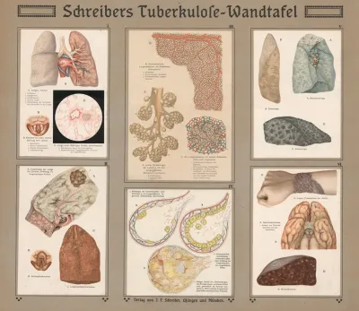 Schreibers Tuberculosis Table