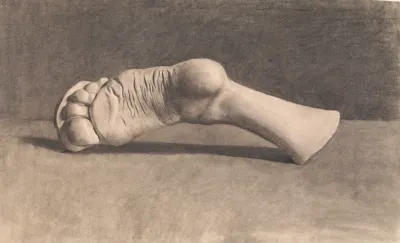 Tegning Efter Gips En Fod