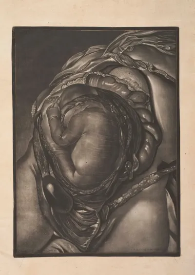The Uterus Is Cut Open And The Fetus Is Represented As It Was Found Lying Under The Membranes