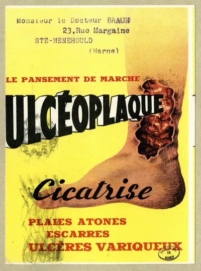 Ulceoplaque
