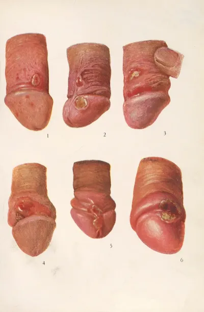 Venereal Diseases Syphilis Pl 01