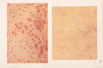 Venereal Diseases Syphilis Pl 07