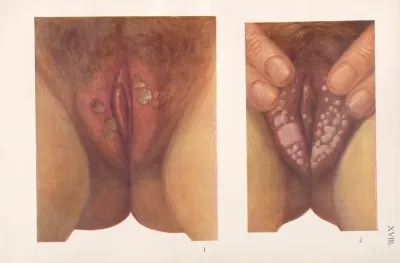 Venereal Diseases Syphilis Pl 18