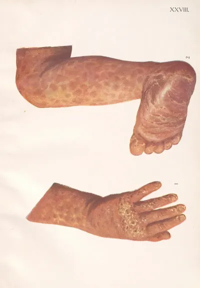 Venereal Diseases Syphilis Pl 28
