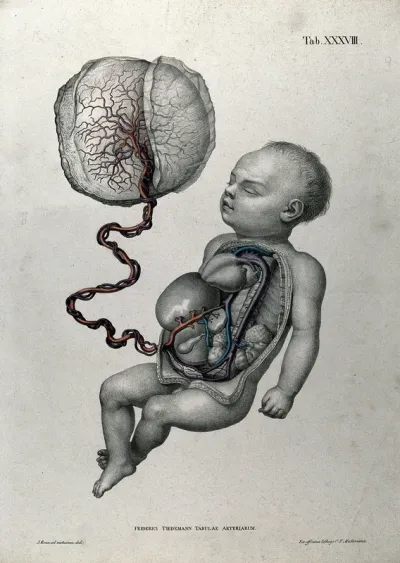 A baby, with thorax and abdomen dissected, attached by umbilical cord to the placenta, with the arteries, blood vessels and veins indicated in red
