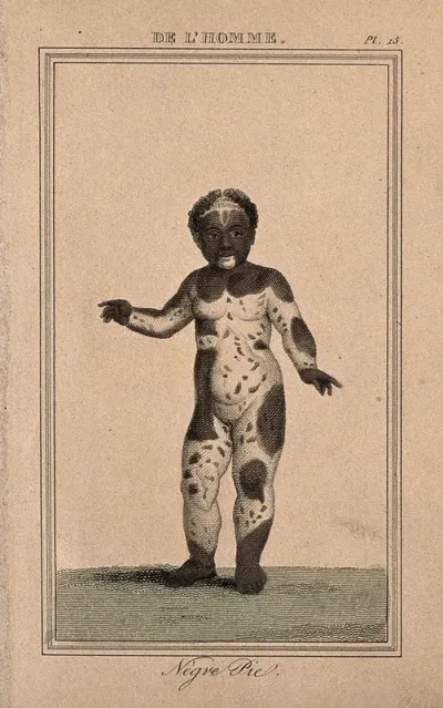A black child displaying areas of white skin across her entire body (vitiligo?)