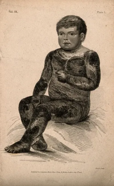 A boy with a variety of icthyosis, a skin disease, which in this case resembles the scales of an alligator