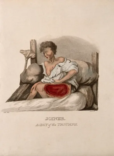 A boy with a wounded thigh seated on a bed; a crutch to his right