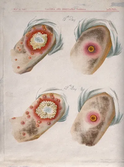 A comparison between smallpox and cowpox pustules on the 12th and 13th days of the disease