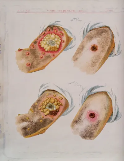 A comparison between smallpox and cowpox pustules on the 14th and 15th days of the disease