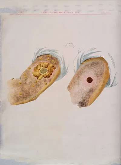 A comparison between smallpox and cowpox pustules on the 16th day of the disease