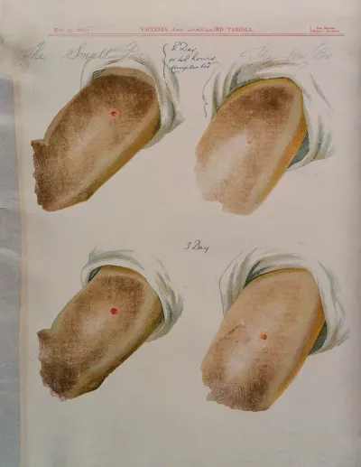 A comparison between smallpox and cowpox pustules on the 2nd and 3rd days of the disease