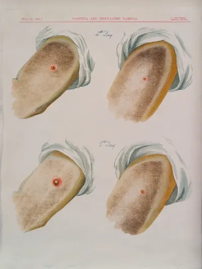 A comparison between smallpox and cowpox pustules on the 4th and 5th days of the disease