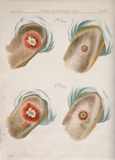 A comparison between smallpox and cowpox pustules on the 8th and 9th days of the disease