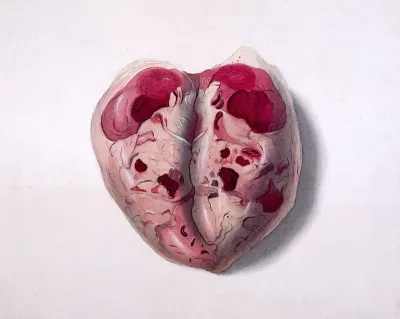 A cystic tumour with necrosis