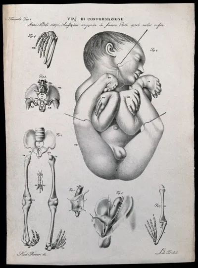 A deformed baby; and examples of skeletal deformity in detail, numbered for key