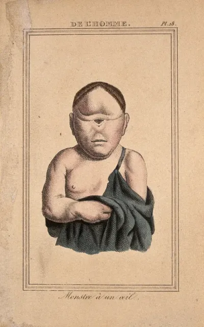 A deformed child with one eye in the centre of its face