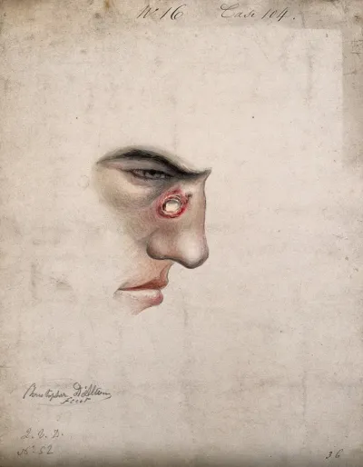 A detail of a man's face seen in profile with a severe disease affecting his nose