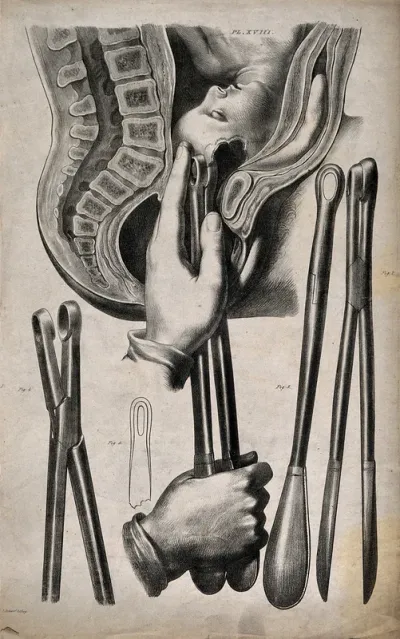 A diagram demonstrating different kinds of forceps, and their use in childbirth