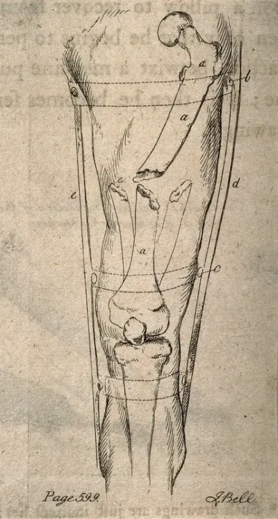 A diagram illustrating an apparatus to bind together a broken leg
